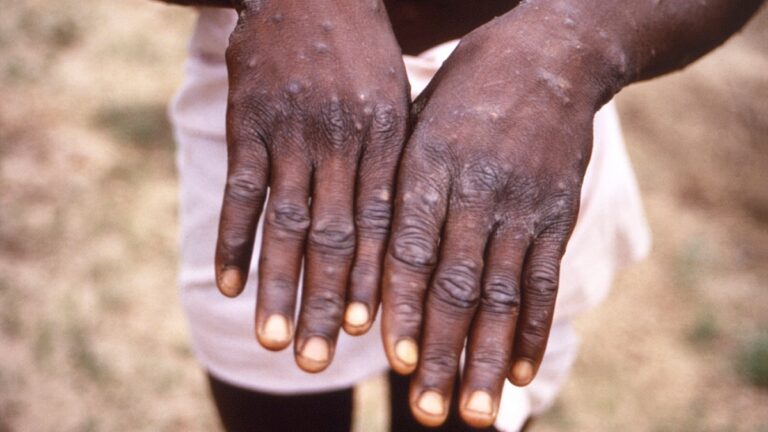 Sud-Kivu : Plus de cinq mille personnes sont guéries de la variole de singe, Mpox